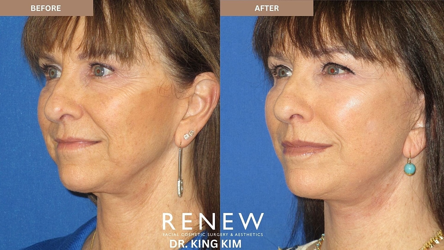 Mini Deep Plane Facelift Before & After