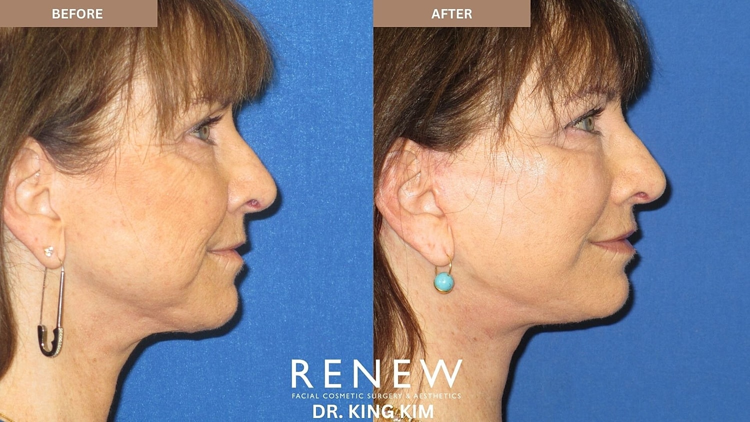Mini Deep Plane Facelift Before & After