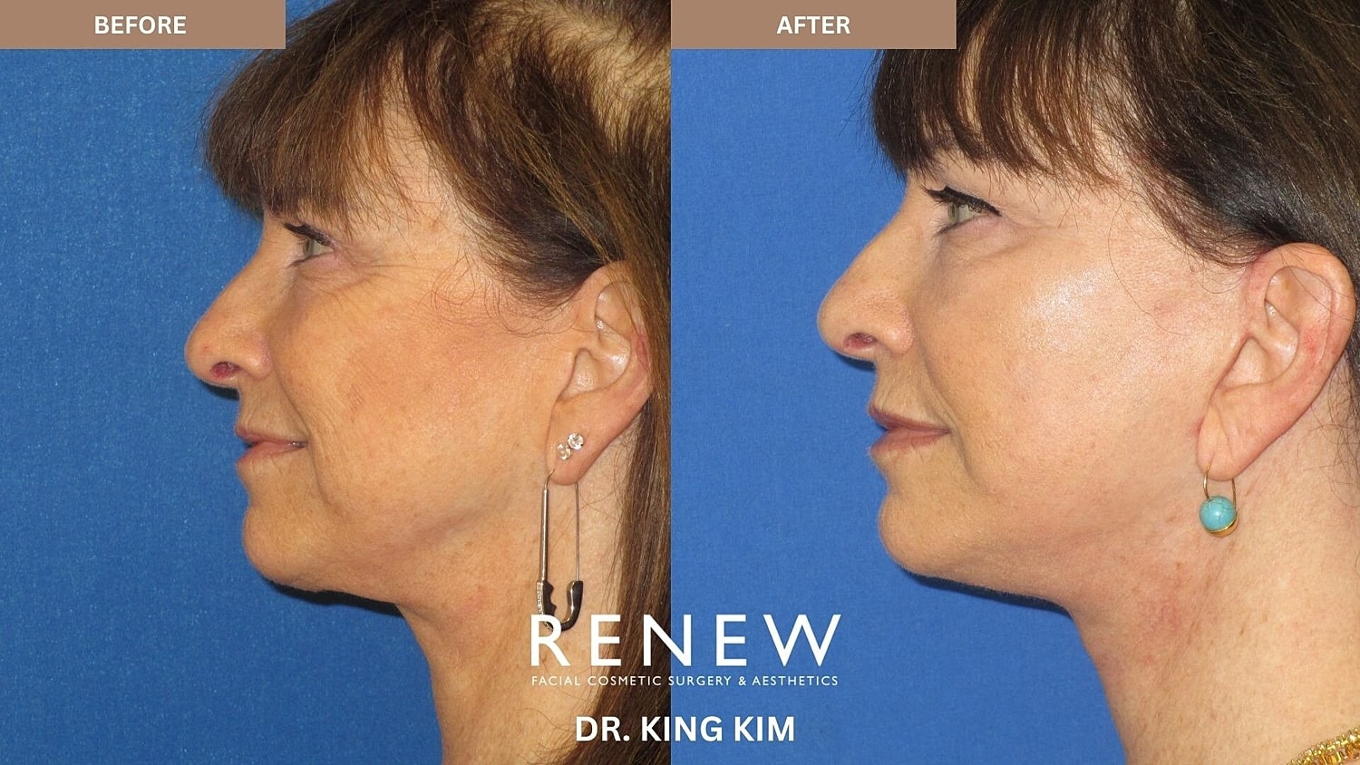 Mini Deep Plane Facelift Before & After