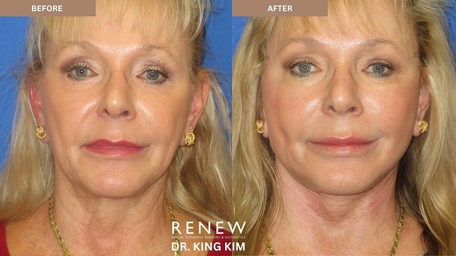 Mini Deep Plane Facelift Before & After