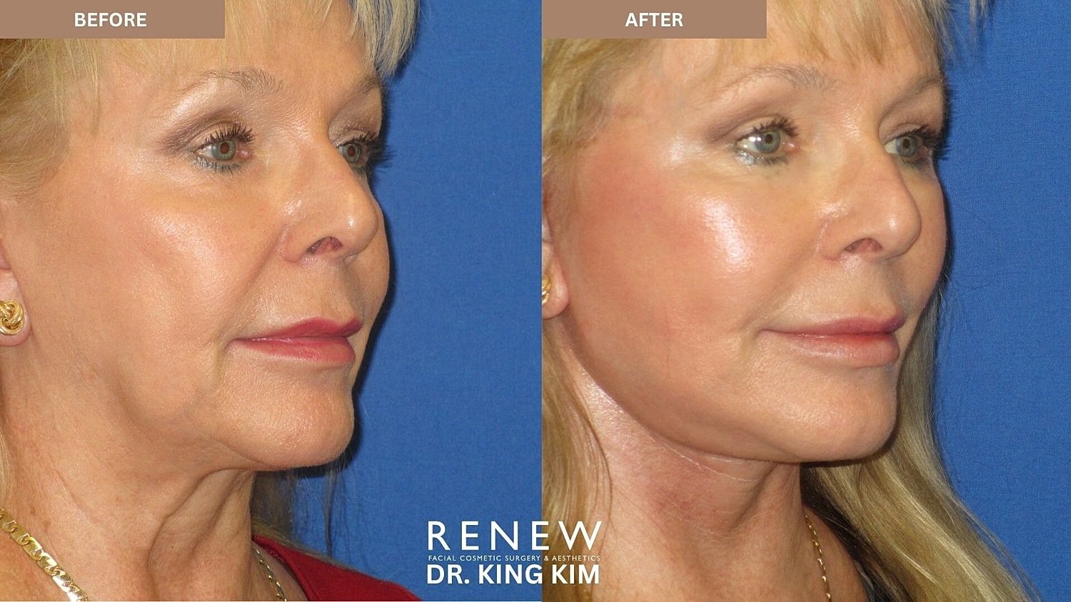 Mini Deep Plane Facelift Before & After