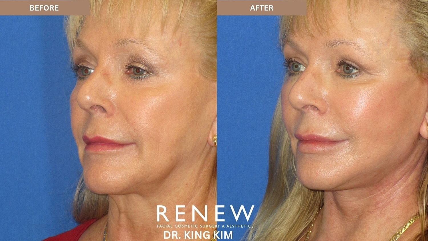 Mini Deep Plane Facelift Before & After