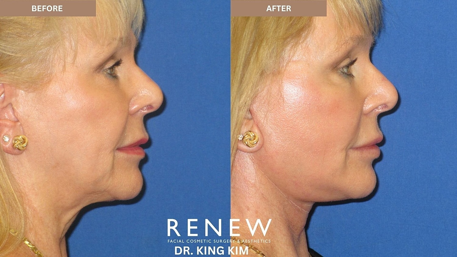 Mini Deep Plane Facelift Before & After