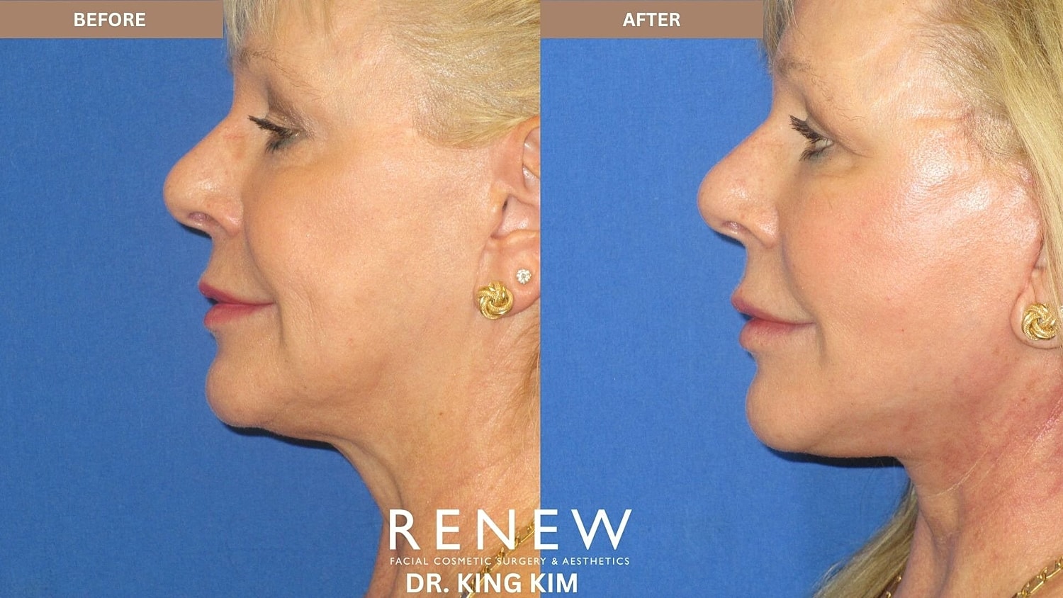 Mini Deep Plane Facelift Before & After