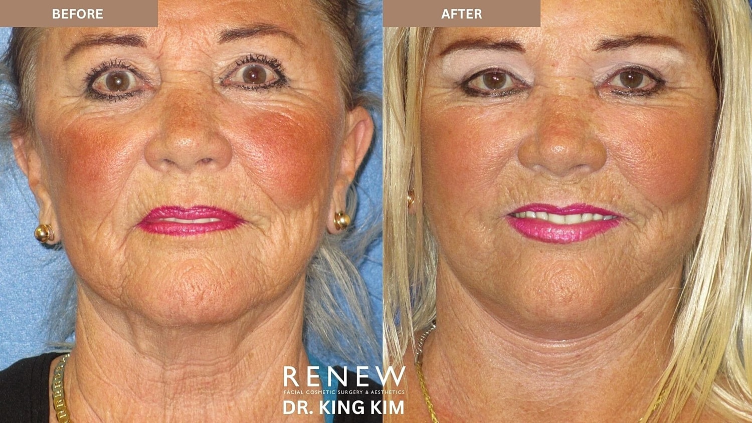 Mini Deep Plane Facelift Before & After