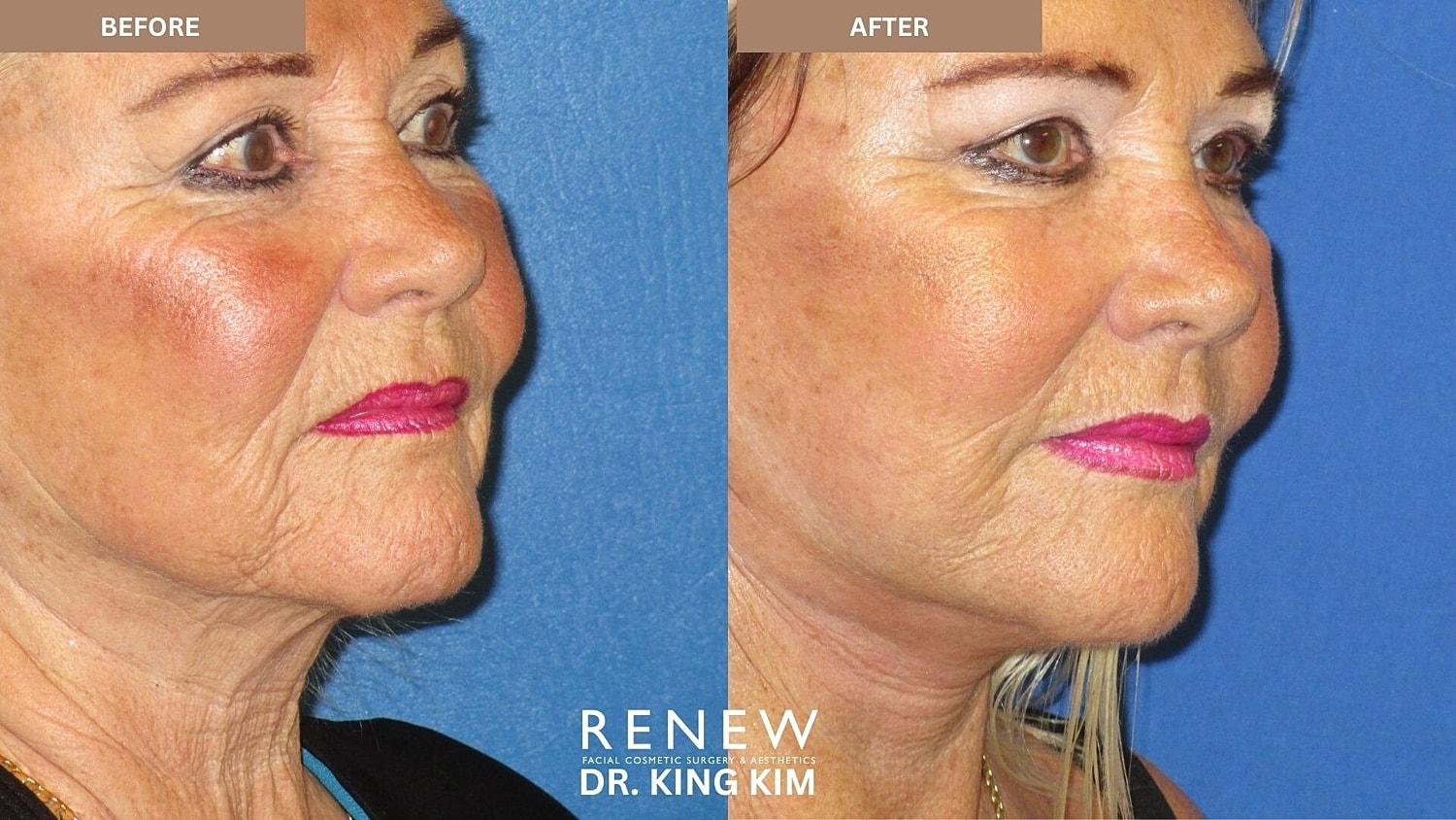 Mini Deep Plane Facelift Before & After