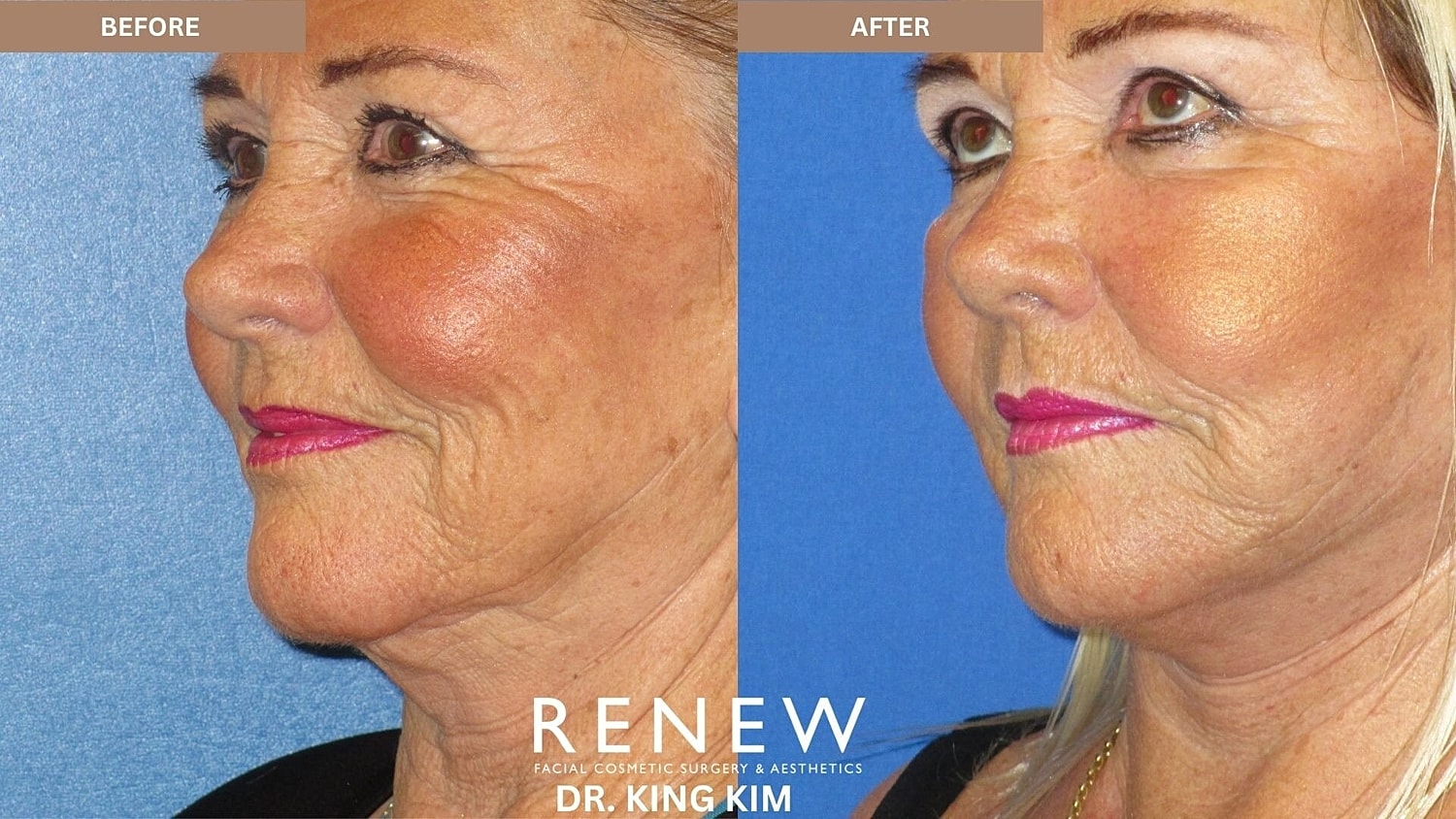 Mini Deep Plane Facelift Before & After