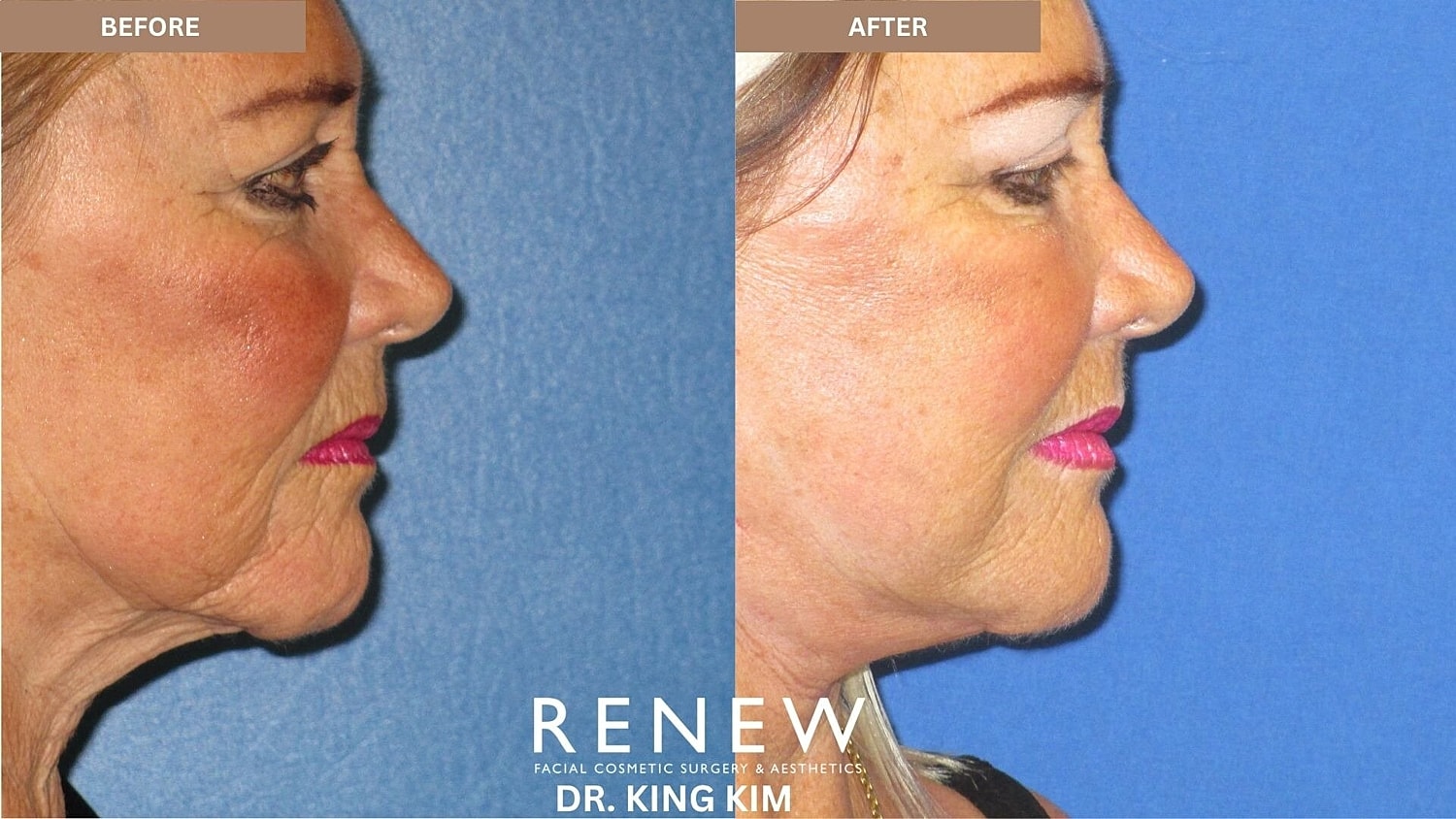Mini Deep Plane Facelift Before & After