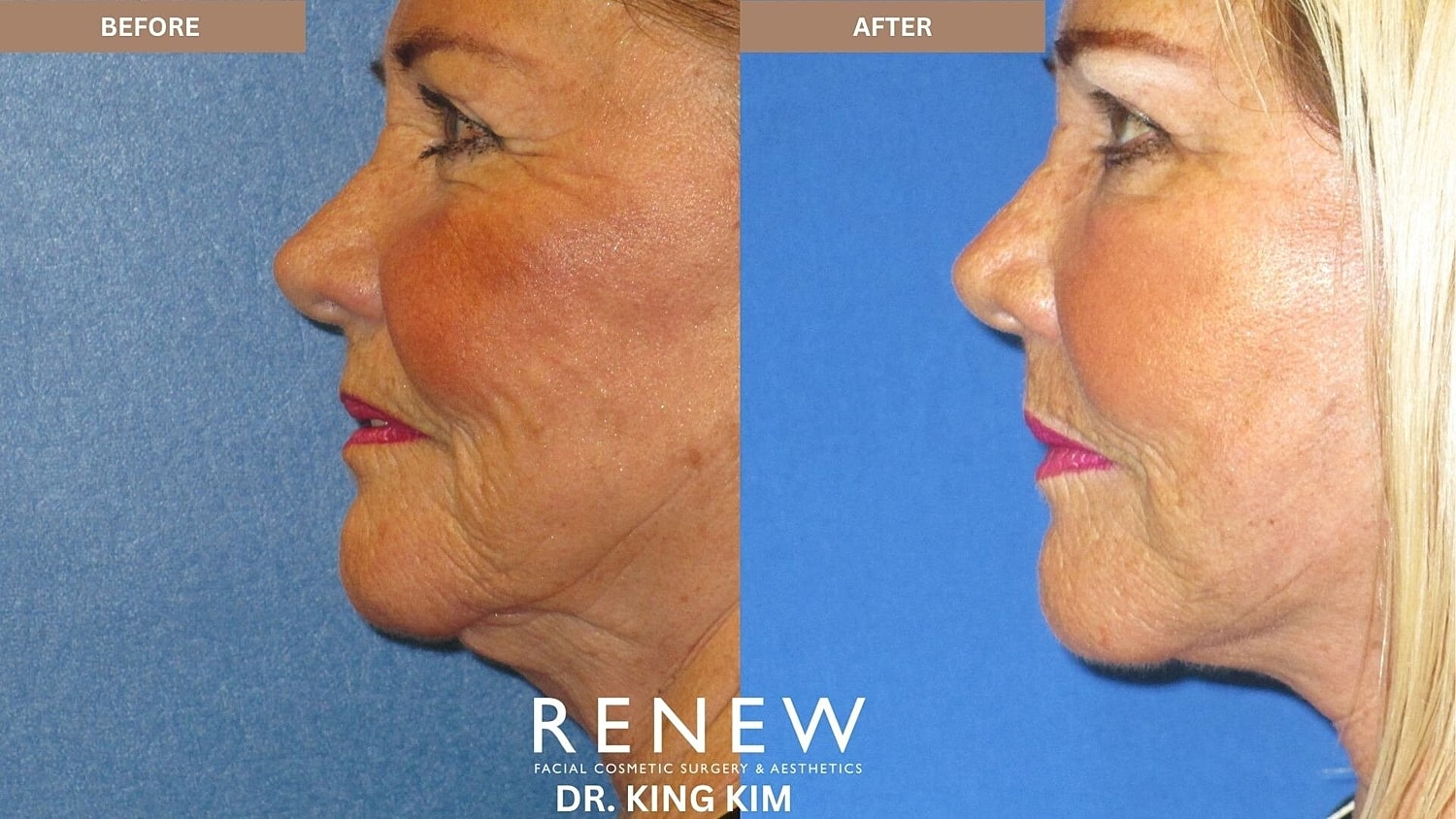 Mini Deep Plane Facelift Before & After