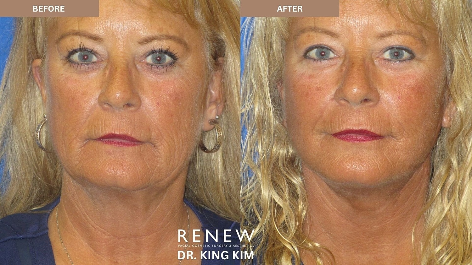 Mini Deep Plane Facelift Before & After