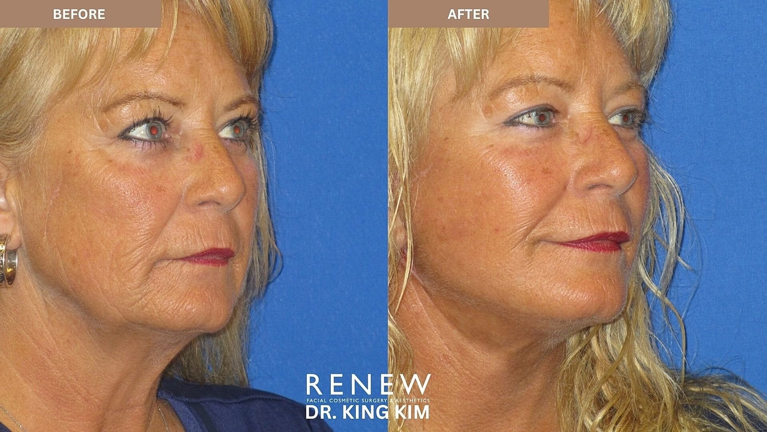 Mini Deep Plane Facelift Before & After