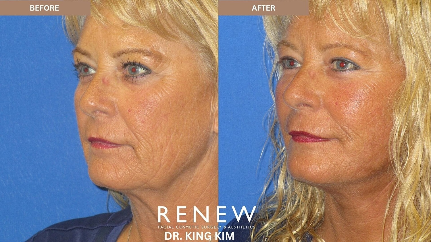 Mini Deep Plane Facelift Before & After