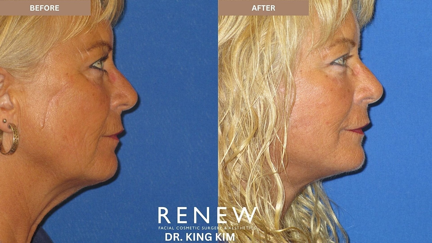 Mini Deep Plane Facelift Before & After
