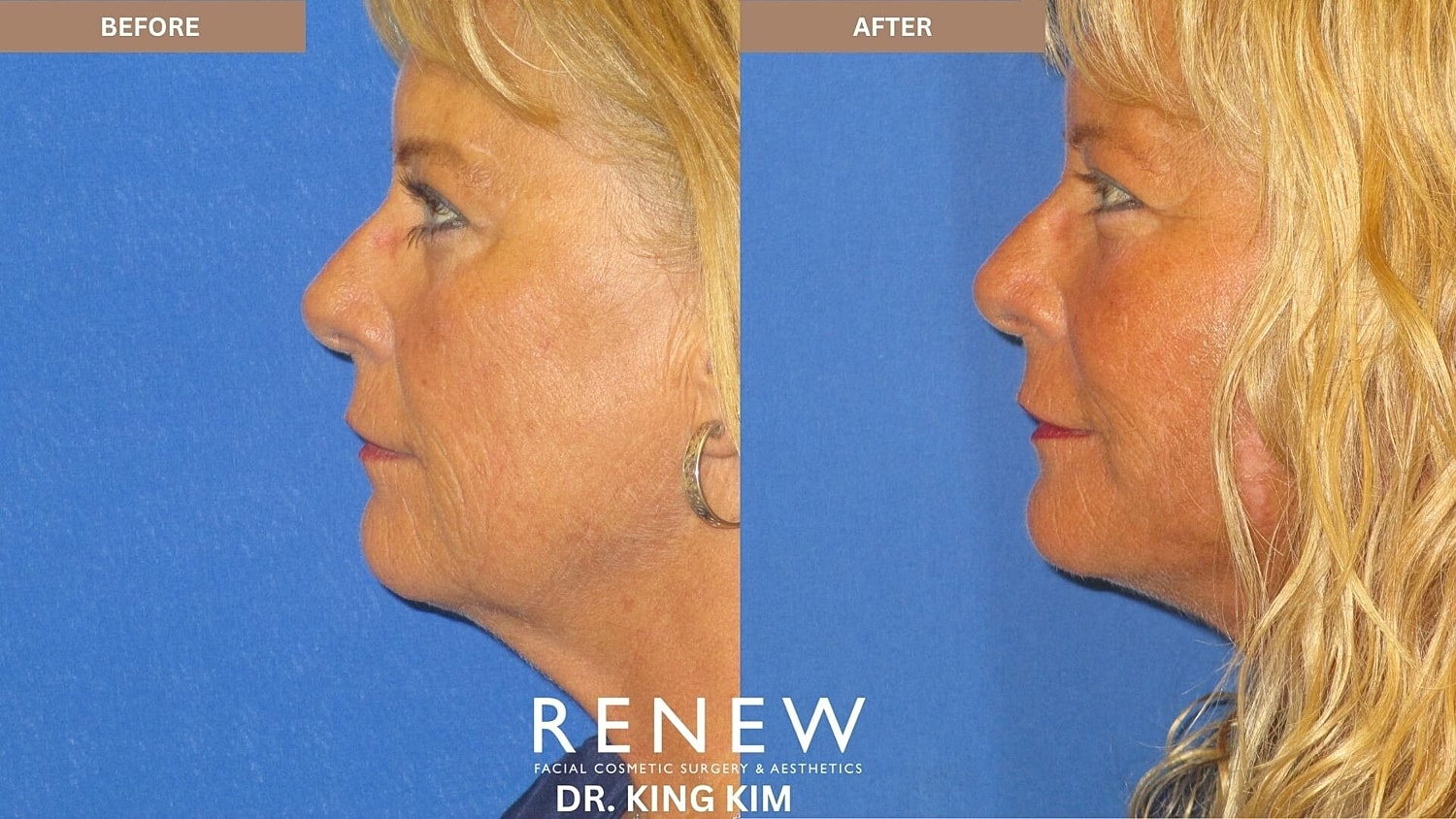 Mini Deep Plane Facelift Before & After