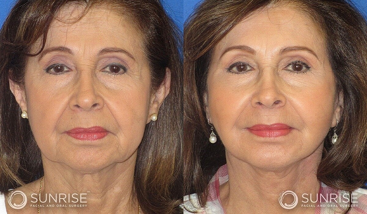 Mini Deep Plane Facelift Before & After