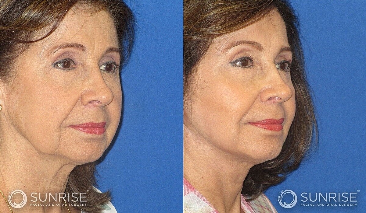 Mini Deep Plane Facelift Before & After