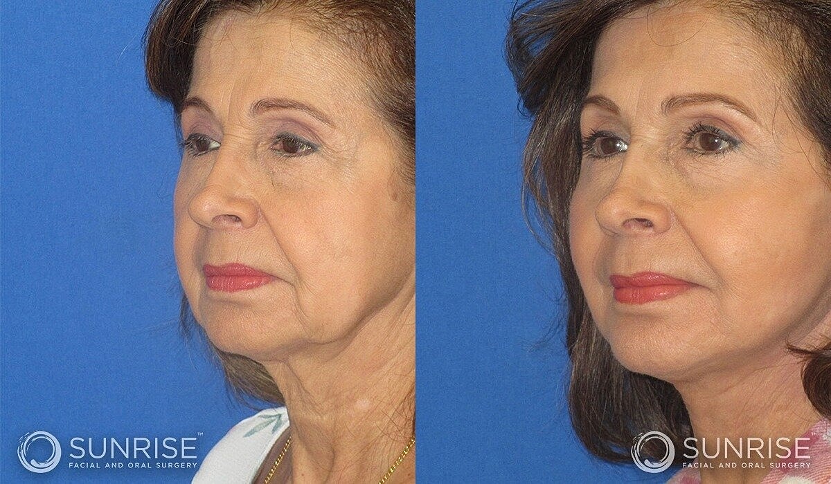 Mini Deep Plane Facelift Before & After