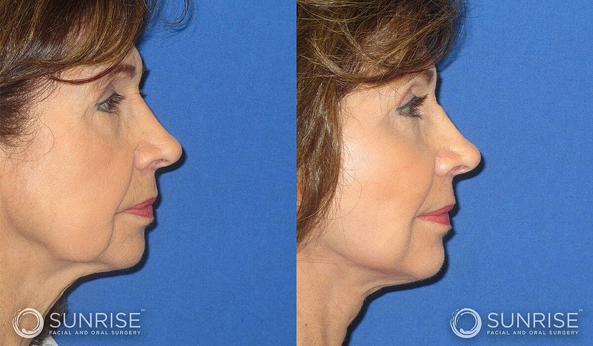 Mini Deep Plane Facelift Before & After