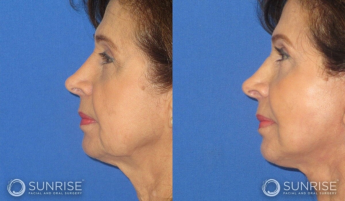 Mini Deep Plane Facelift Before & After