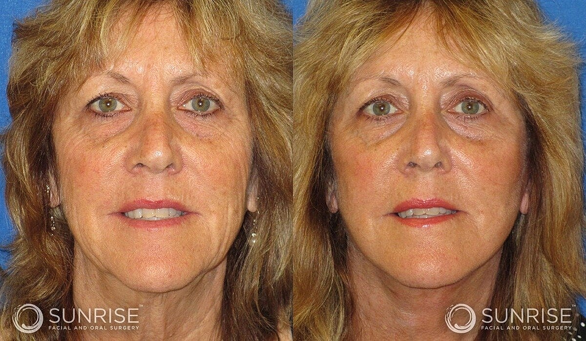 Mini Deep Plane Facelift Before & After