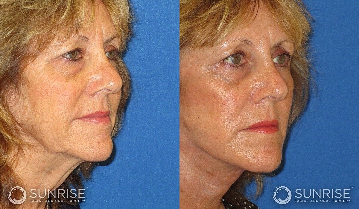 Mini Deep Plane Facelift Before & After
