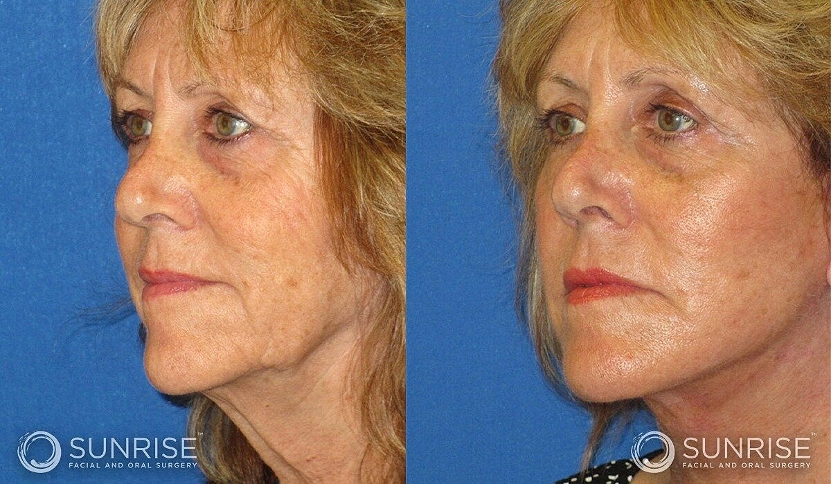 Mini Deep Plane Facelift Before & After