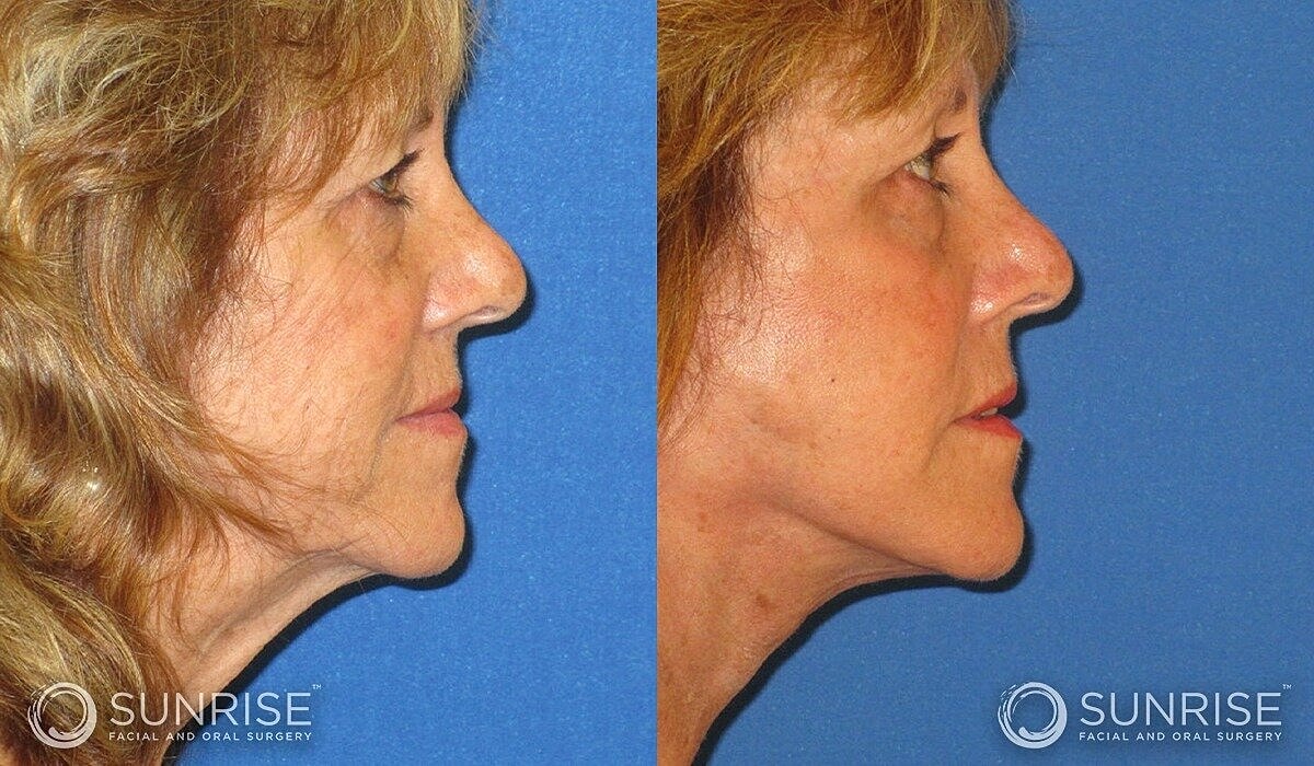Mini Deep Plane Facelift Before & After