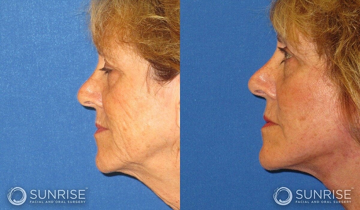 Mini Deep Plane Facelift Before & After
