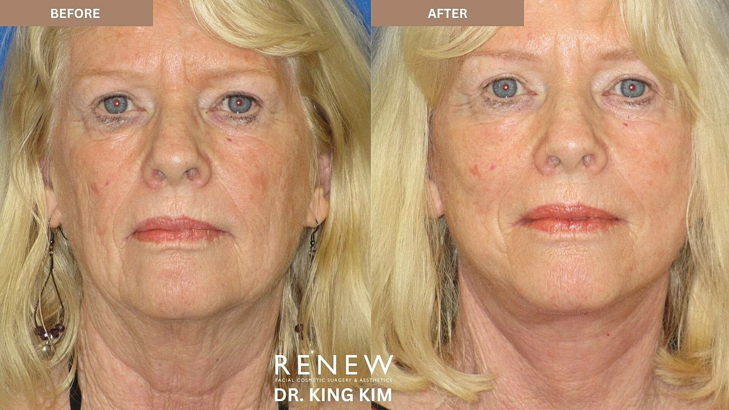 Mini Deep Plane Facelift Before & After