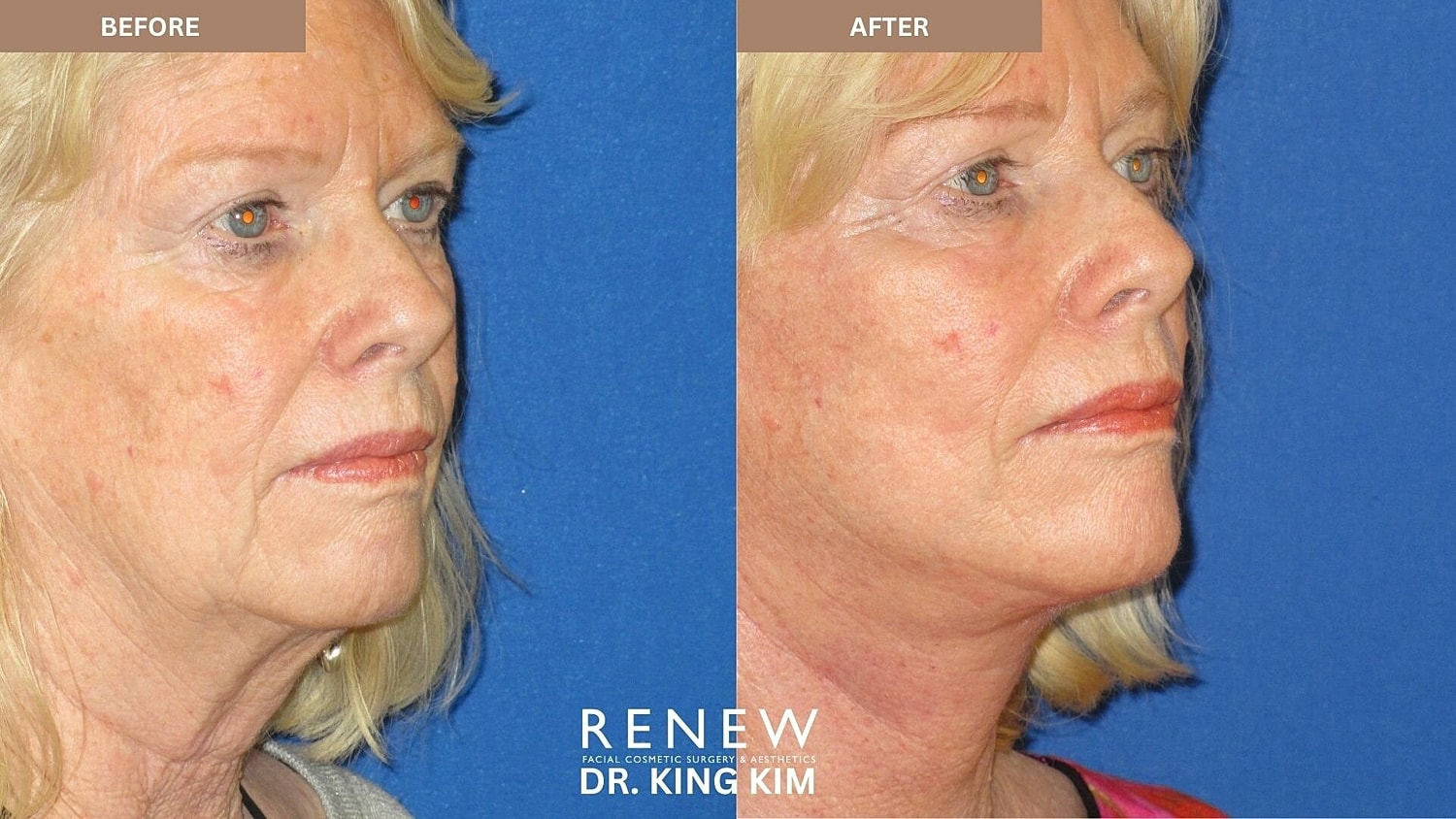 Mini Deep Plane Facelift Before & After
