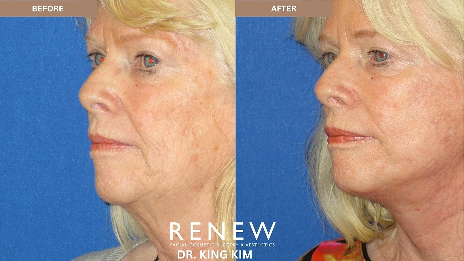 Mini Deep Plane Facelift Before & After