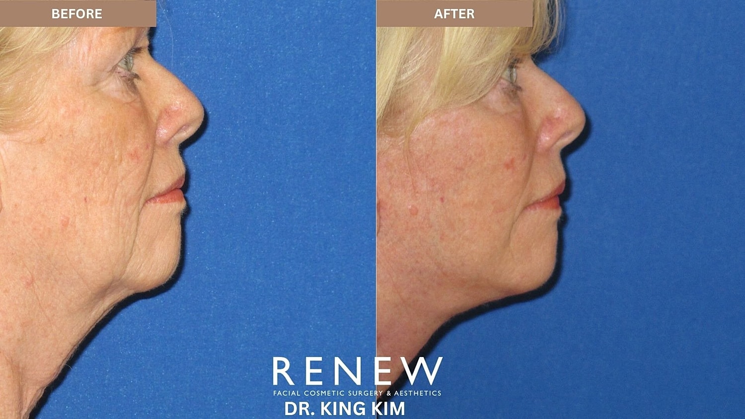 Mini Deep Plane Facelift Before & After
