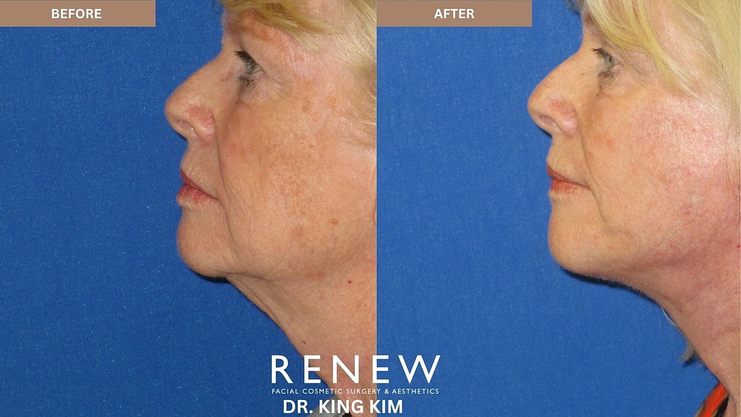 Mini Deep Plane Facelift Before & After