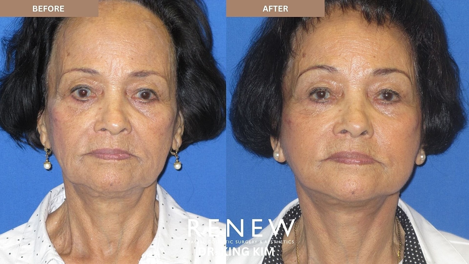 Mini Deep Plane Facelift Before & After