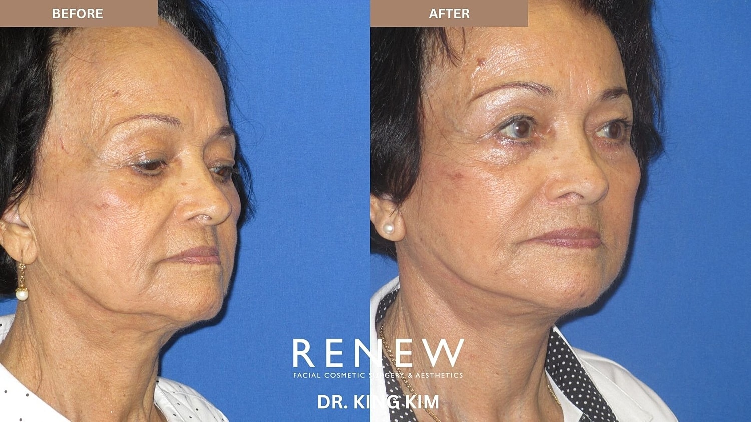 Mini Deep Plane Facelift Before & After