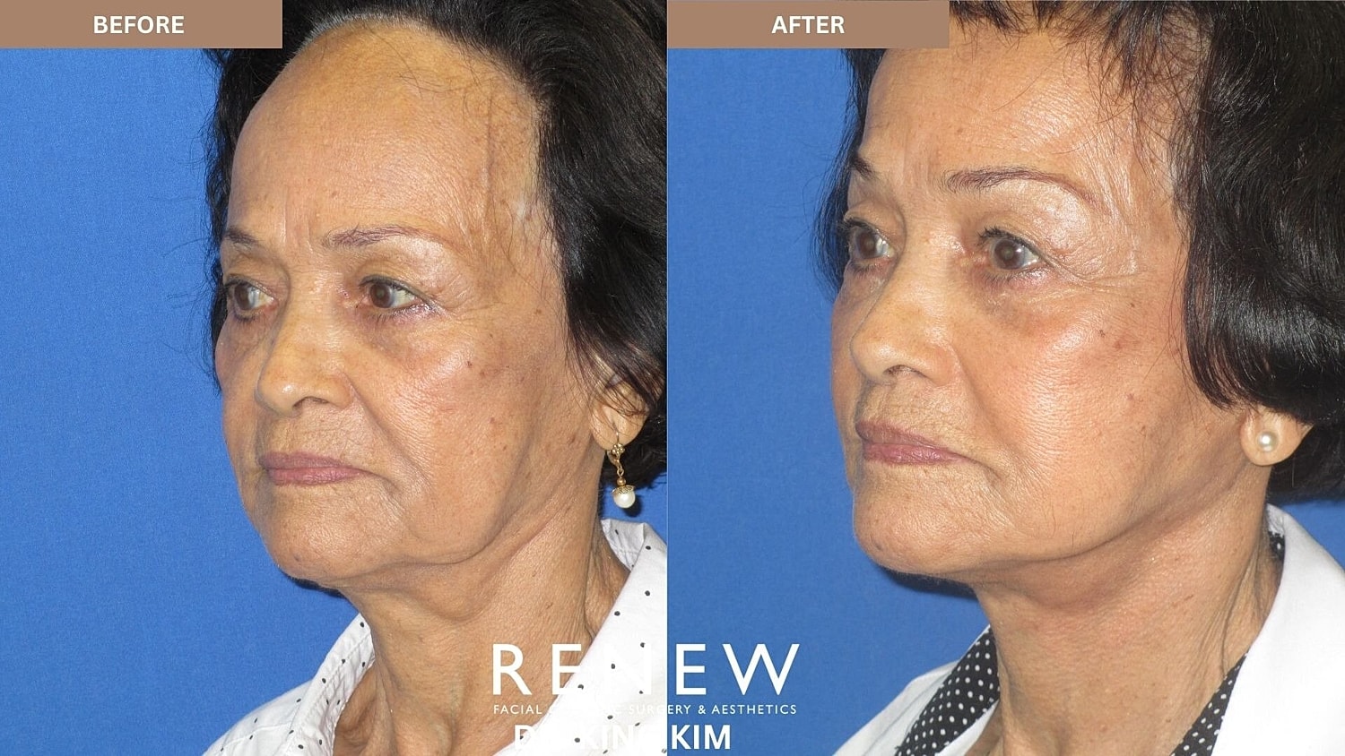 Mini Deep Plane Facelift Before & After