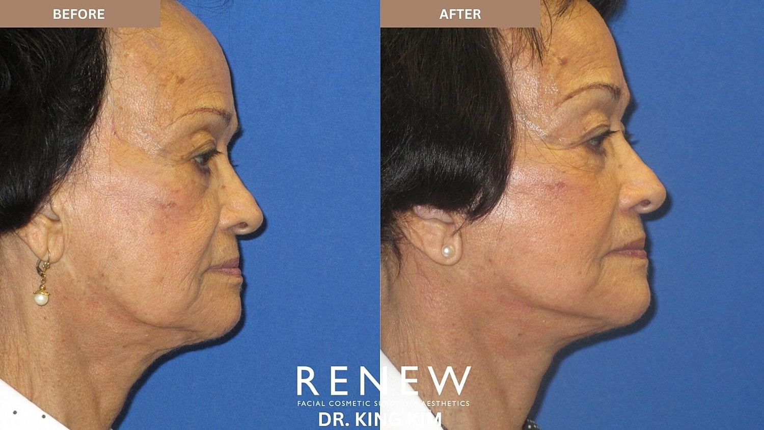 Mini Deep Plane Facelift Before & After