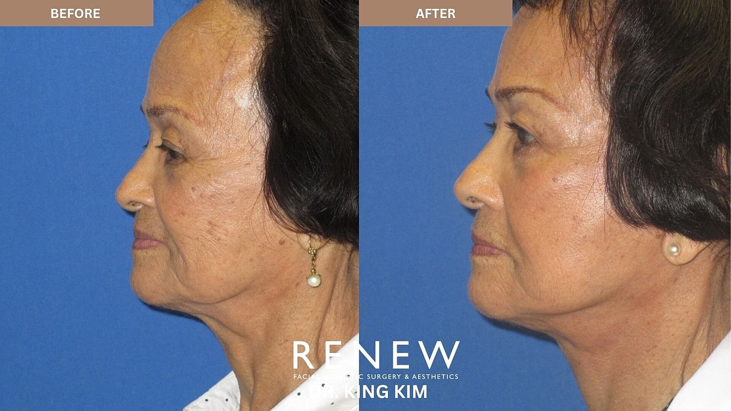 Mini Deep Plane Facelift Before & After