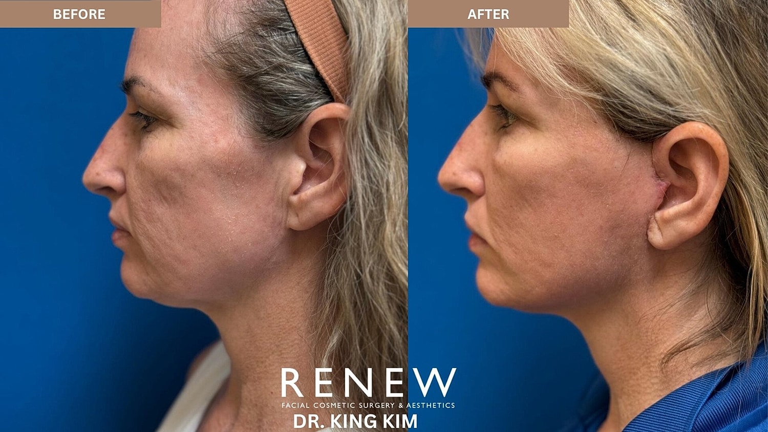 Weekend Facelift Before & After