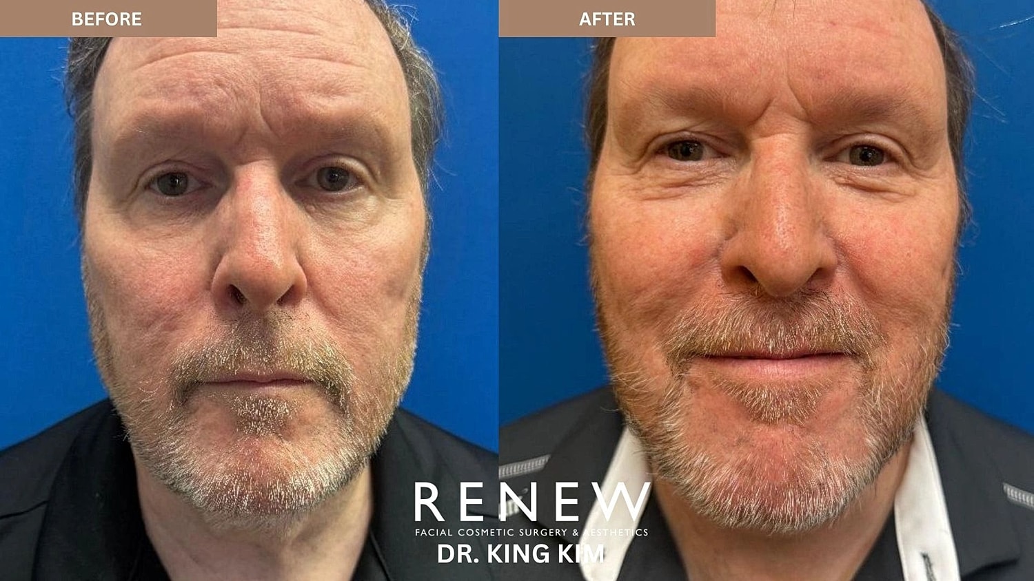 Necklift Before & After