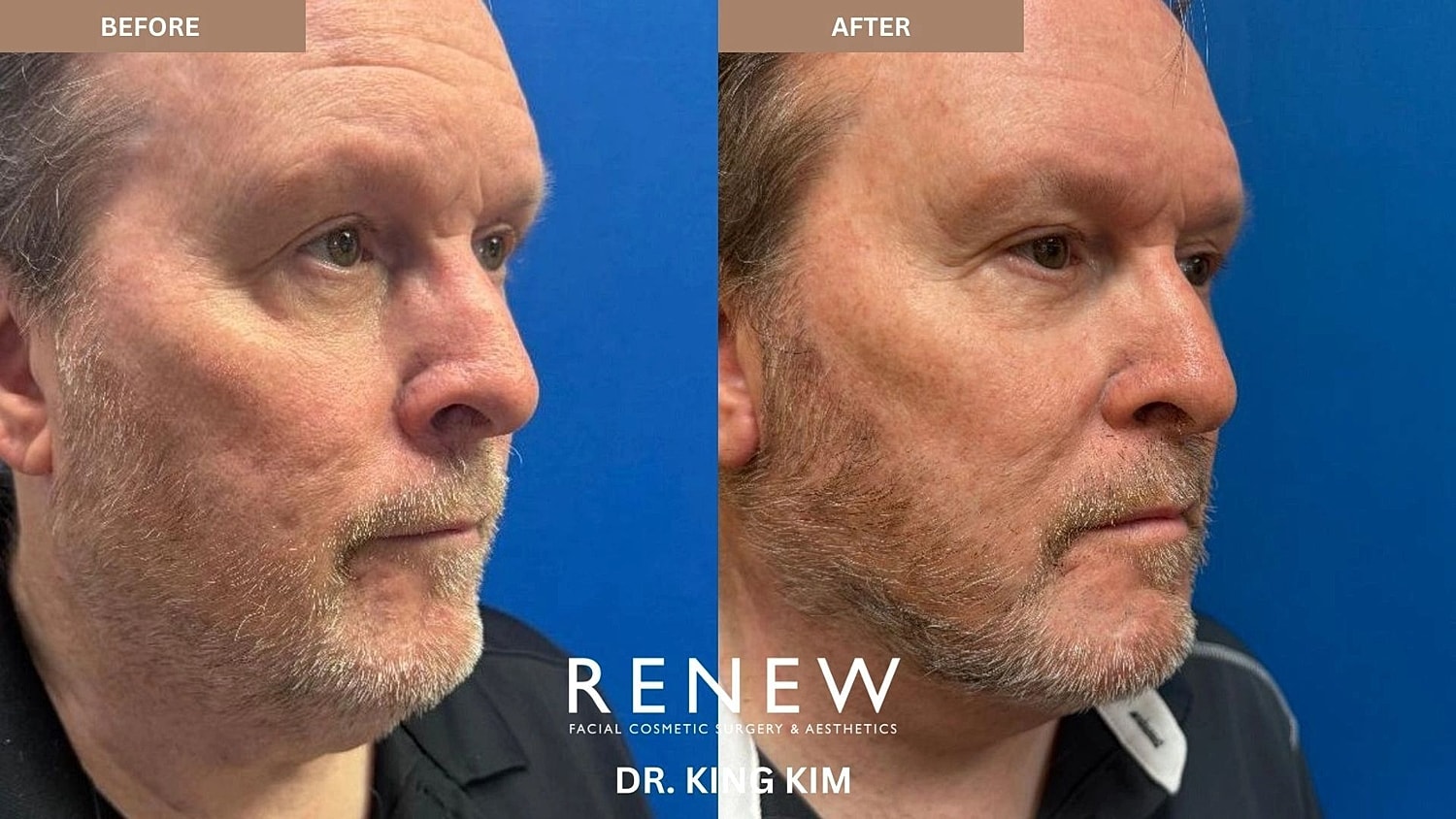 Necklift Before & After