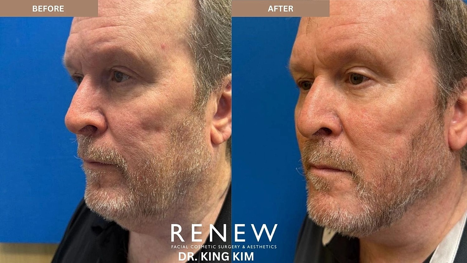 Necklift Before & After