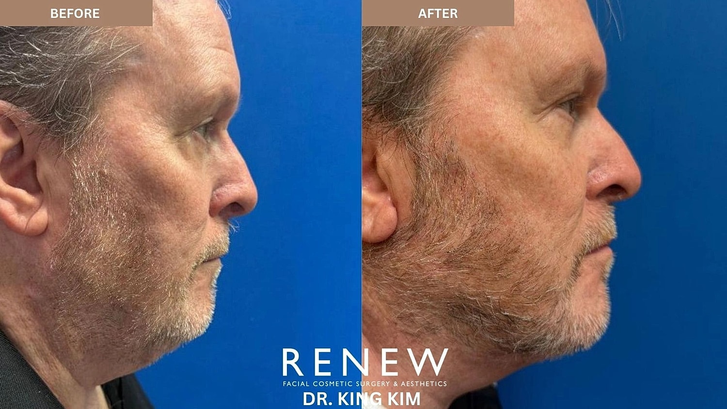 Necklift Before & After
