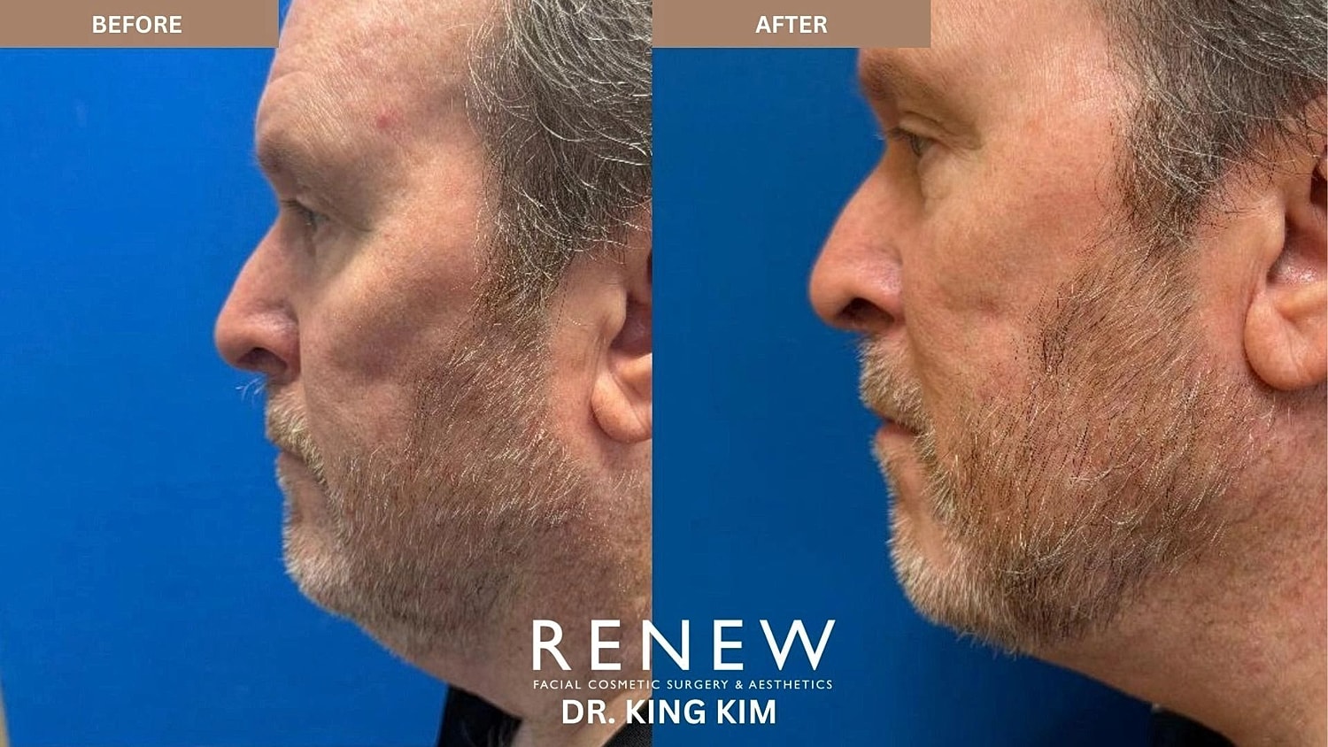 Necklift Before & After