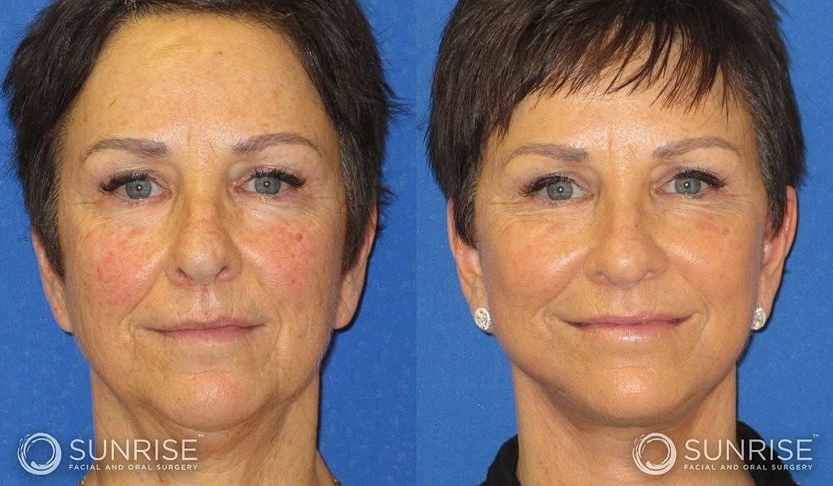 Necklift Before & After
