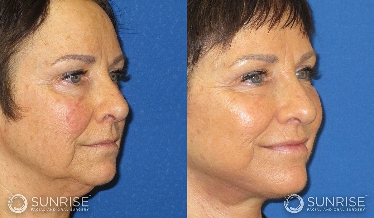 Necklift Before & After