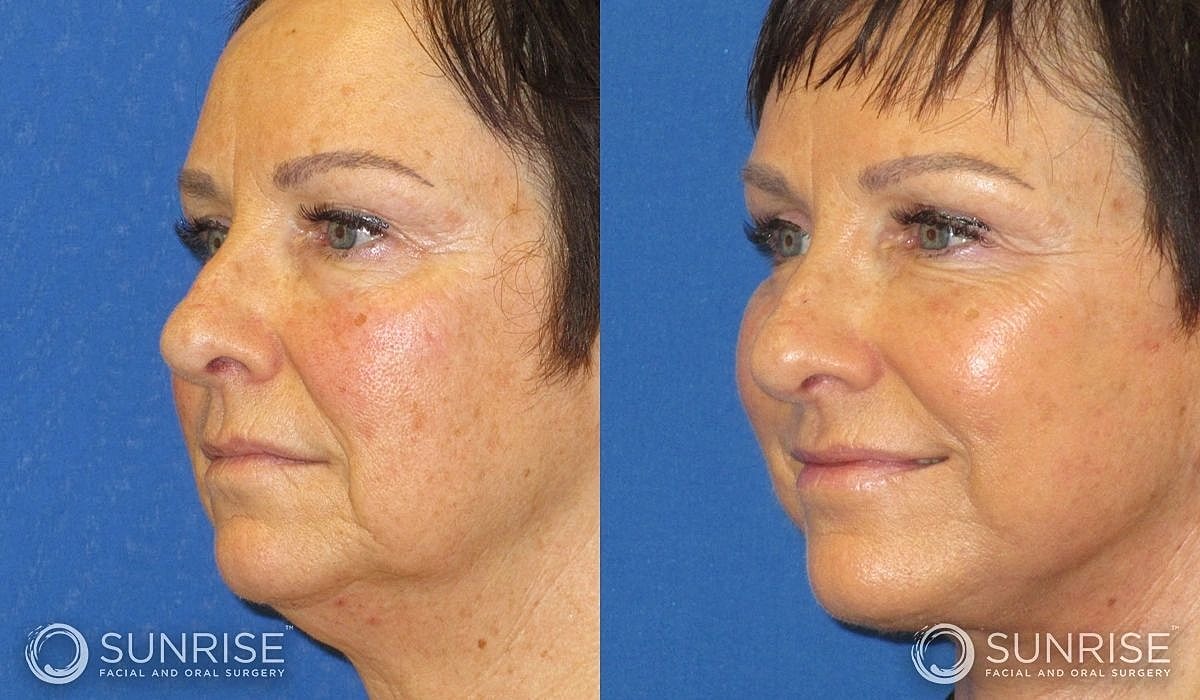 Necklift Before & After