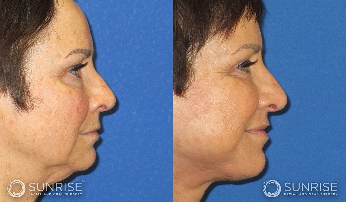 Necklift Before & After