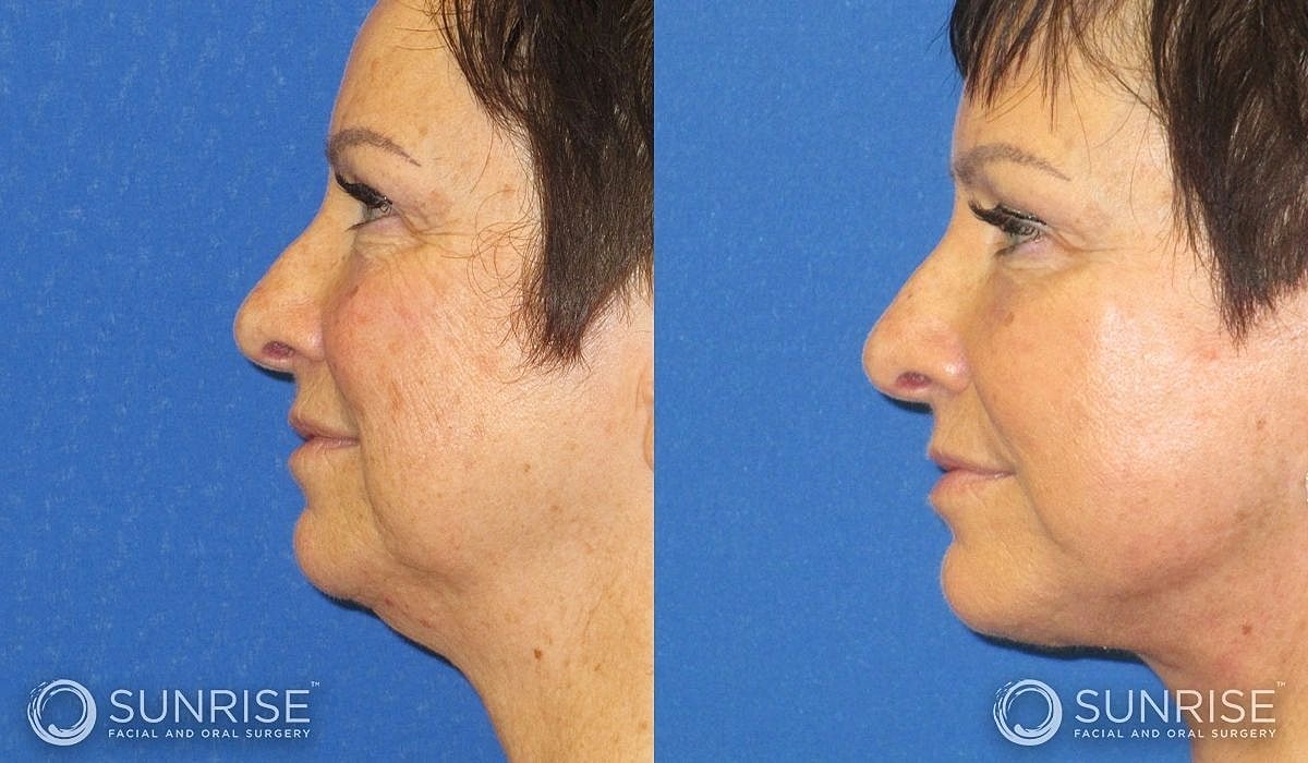Necklift Before & After