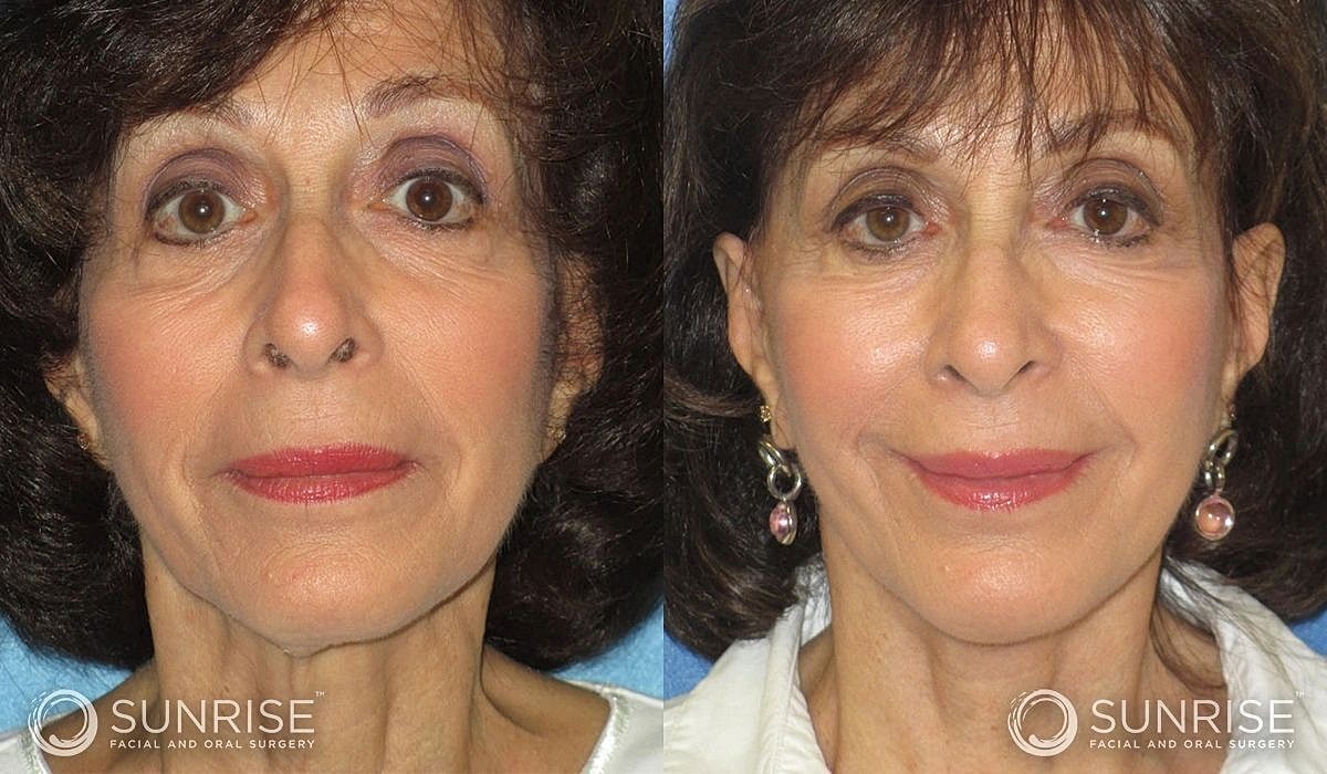 Necklift Before & After